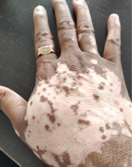 Let's Understand Vitiligo